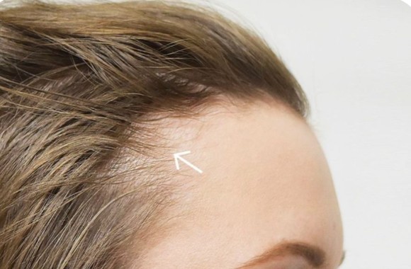 Follicular Miniaturization Baseline