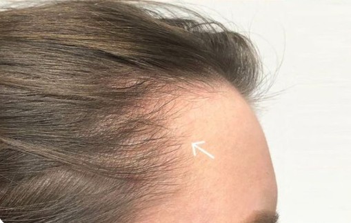Regrowth Stage After Exosome Therapy