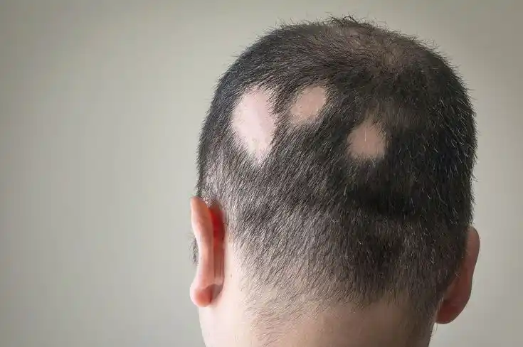 Patchy Hair Loss Baseline