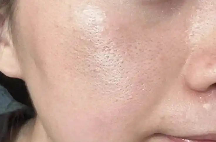 Skin Texture Before Treatment