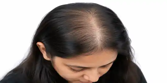 Scalp Before GFC Treatment
