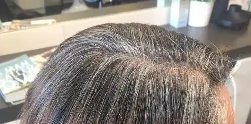Baseline Premature Greying