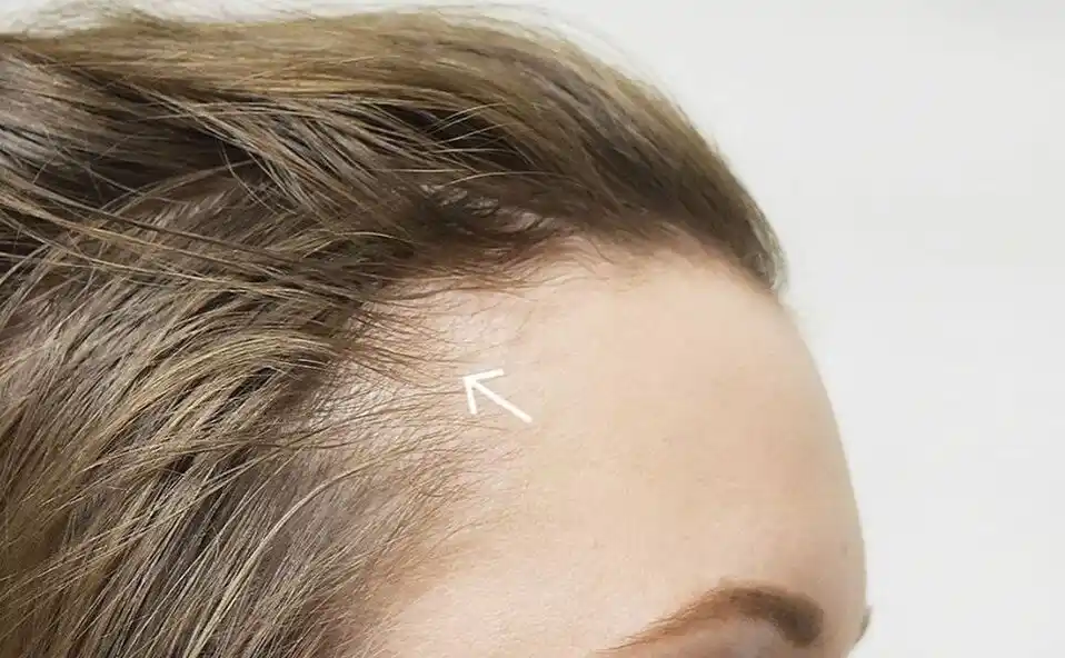 Regrowth Stage After Clinical Hair Restoration