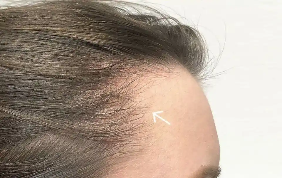 Clinical Baseline Hair Loss