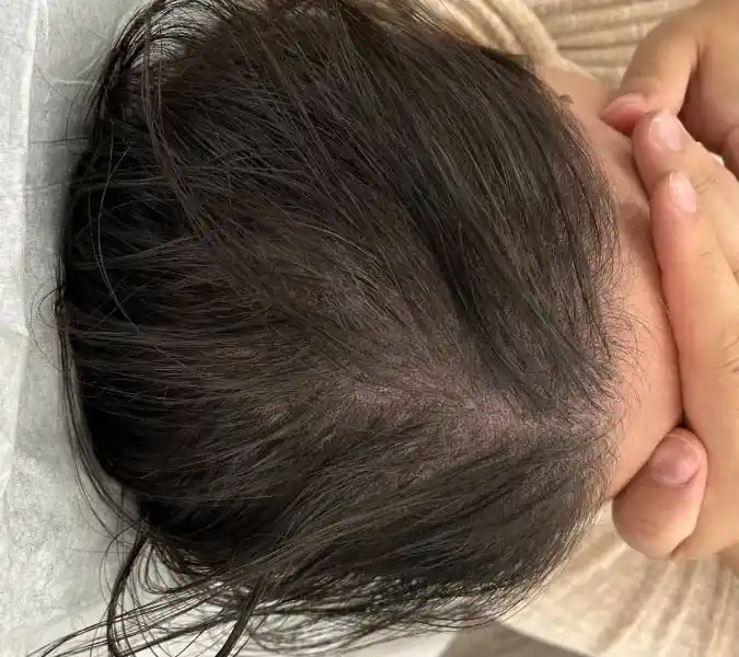 Scalp After Laser Treatment