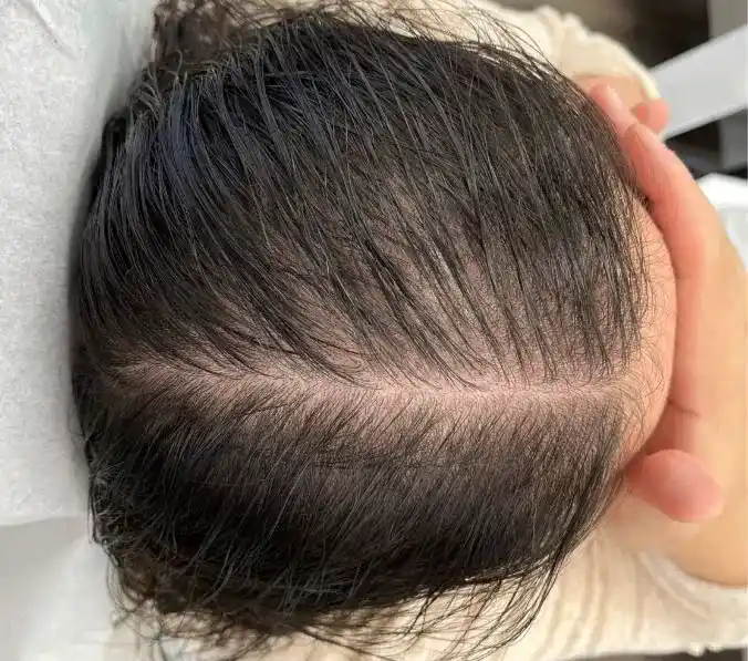 Scalp Before HVT Treatment