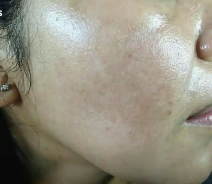 Skin After Treatment