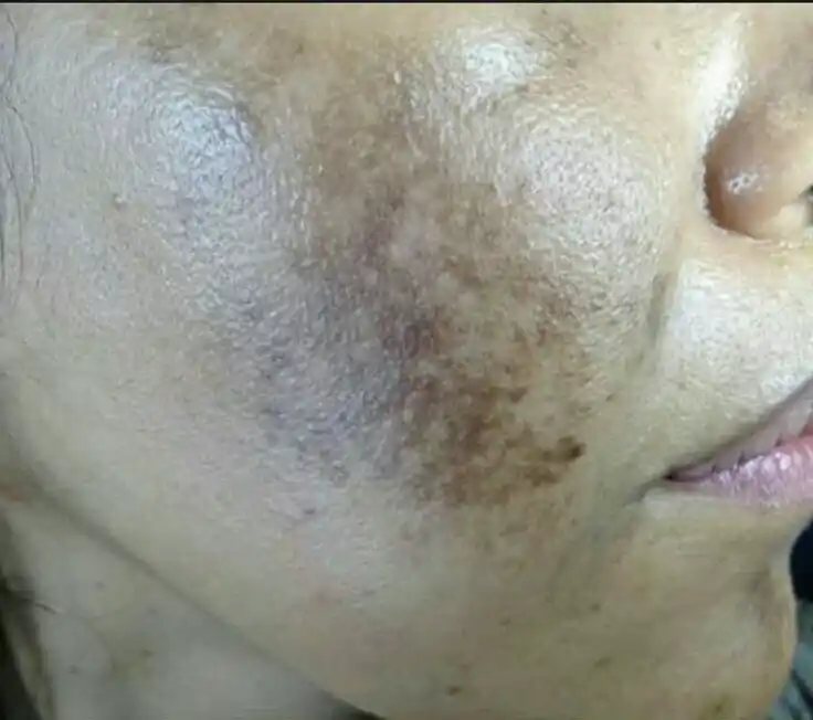 Skin Before Treatment