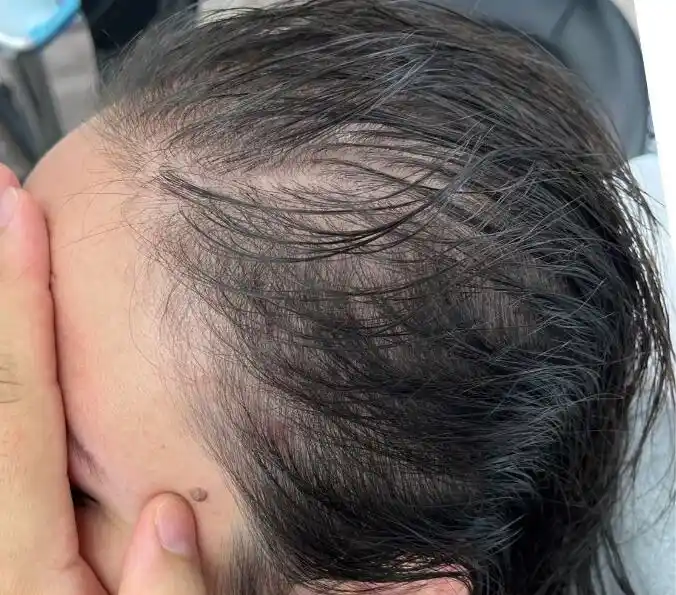 Thinning Scalp Pattern Before Treatment