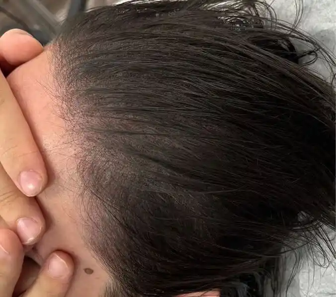Improved Density After Mesotherapy