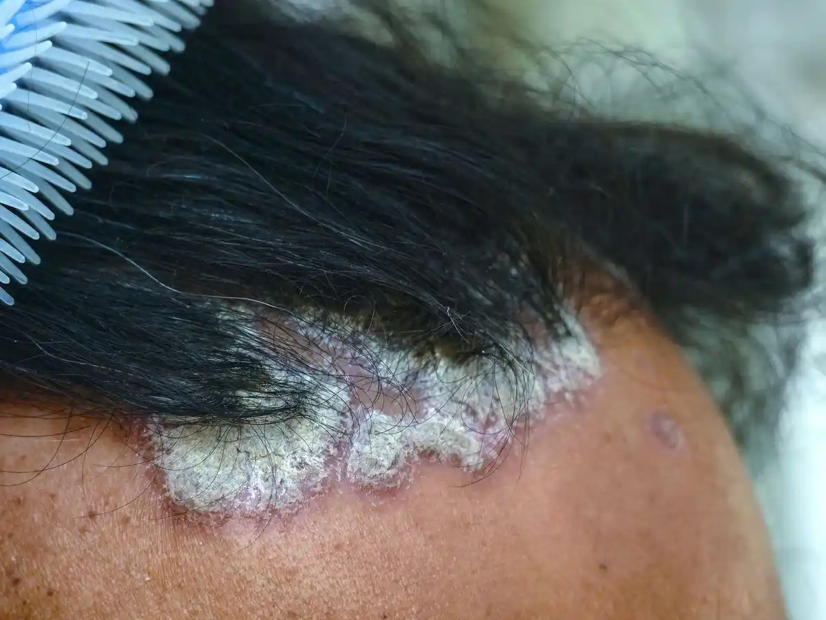 Seborrheic Dermatitis Initial Flakes