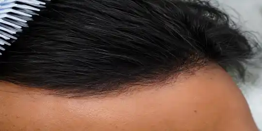 Clear Scalp Follow up