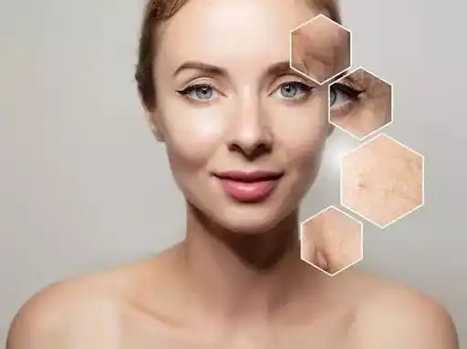 acne scar