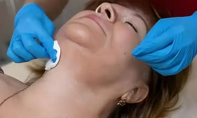Peels