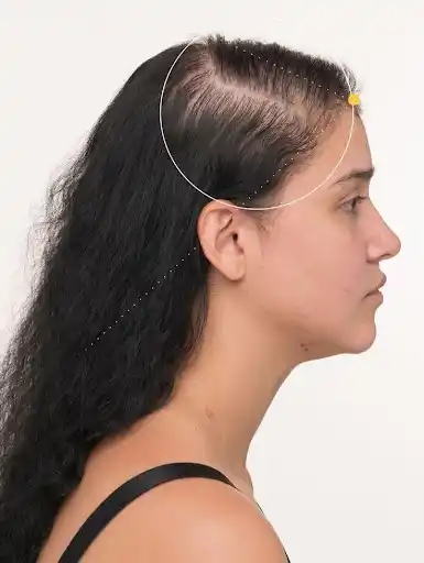 Sunburn tan removal