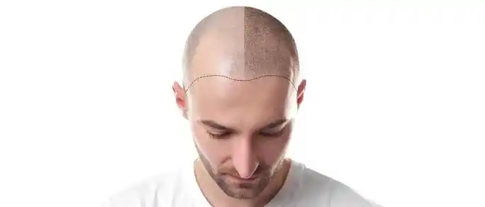 Hair Transplant