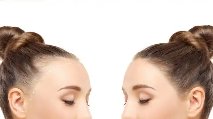 Sunburn tan removal