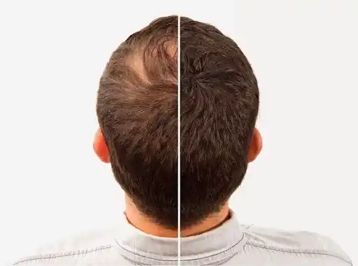 Sunburn tan removal