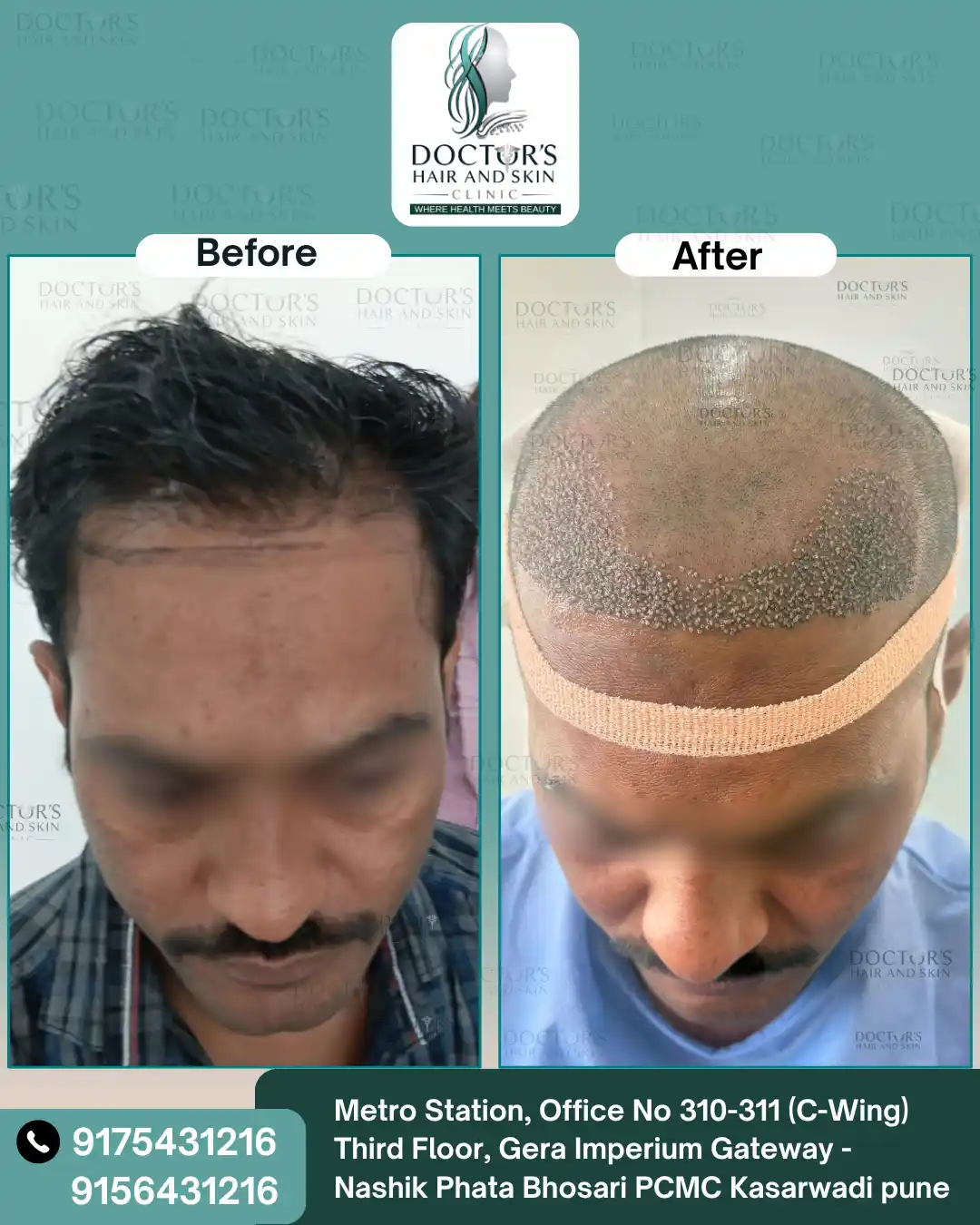 Before and After Result 1