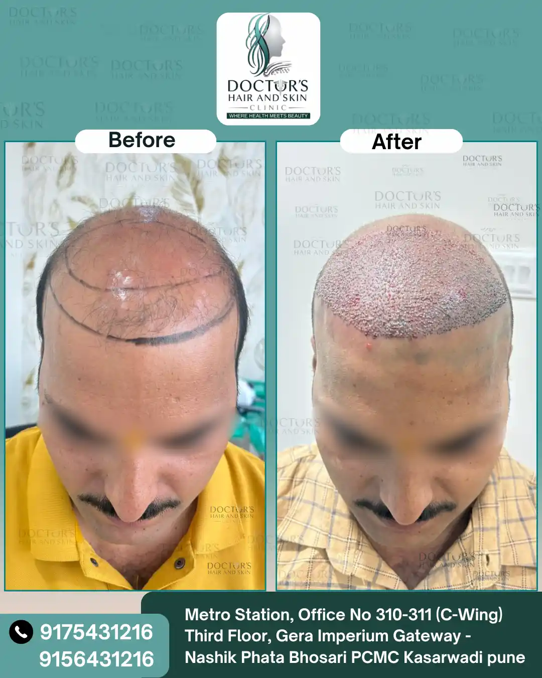 Before and After Result 2