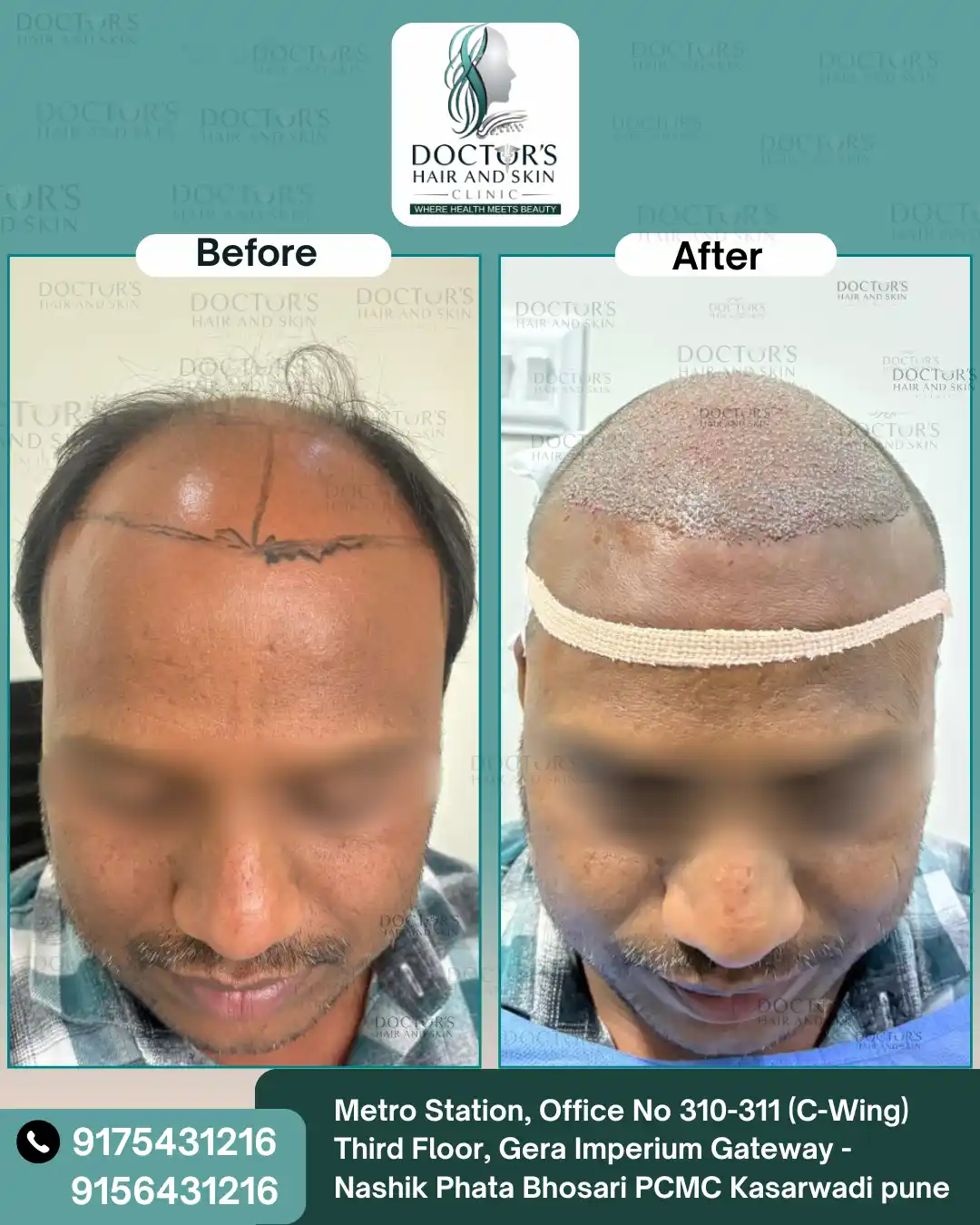 Before and After Result 4