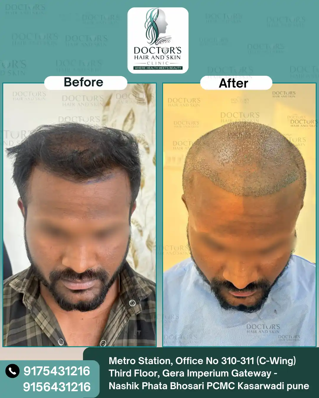 Hair Result 5