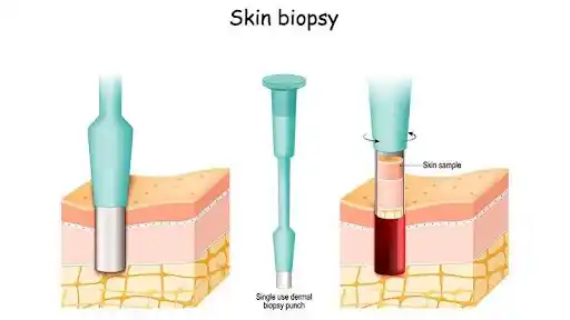 skin biopsy