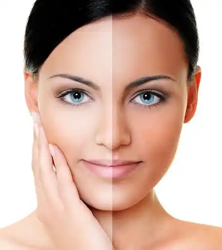 Sunburn tan removal