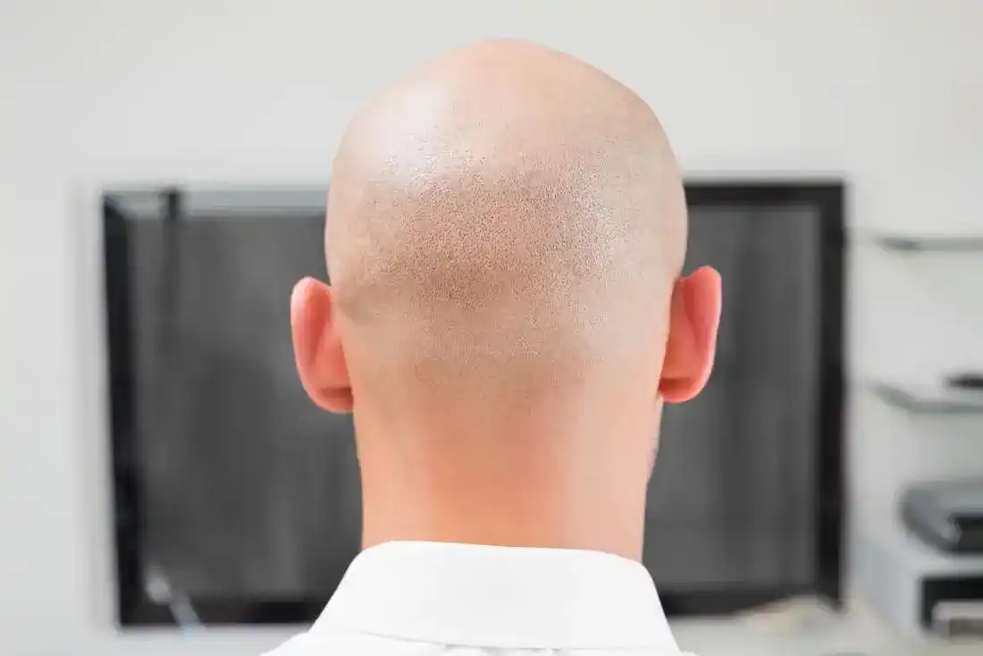 Alopecia Totalis
